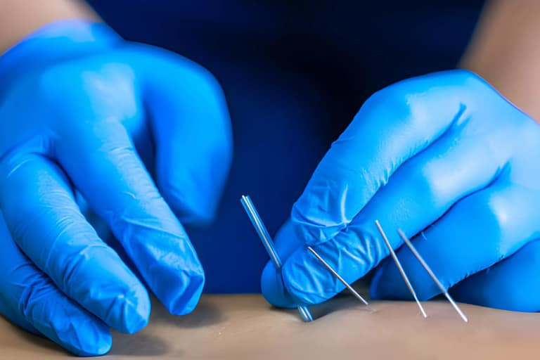 Dry Needling